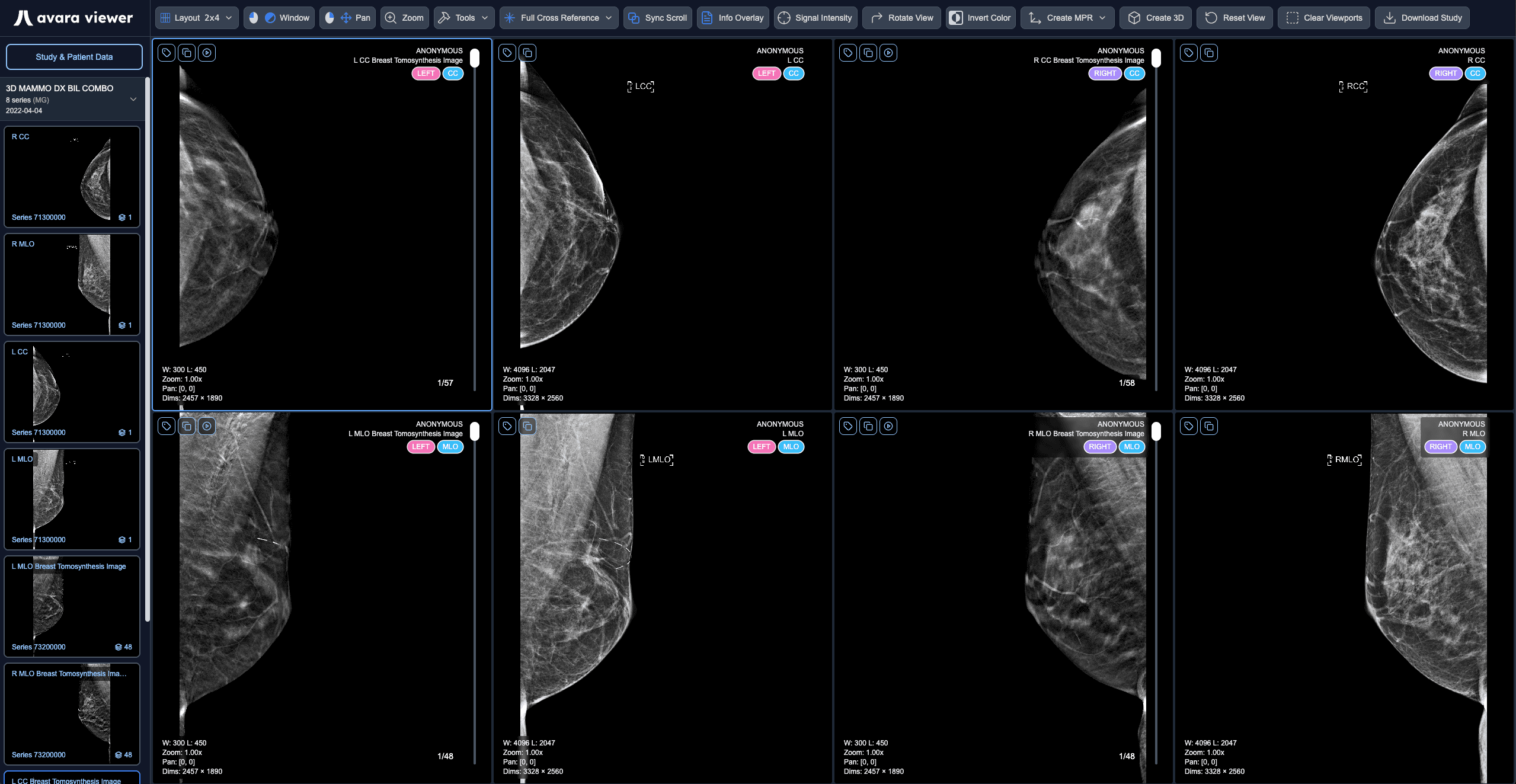 Mammography Hanging Protocol Layout
