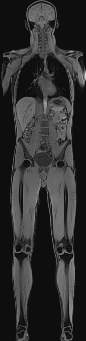 Full Body MRI